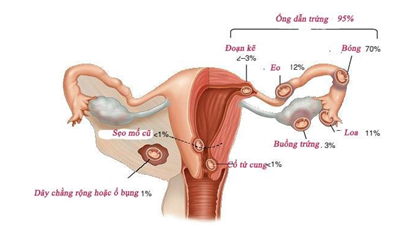 Thai làm tổ tại sẹo mổ lấy thai